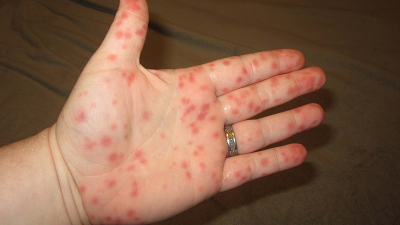 Virus Hanta gây nên hội chứng thận kèm sốt xuất huyết